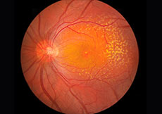 Age-related Macular Degeneration (AMD)