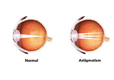 Astigmatism