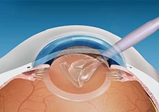 Cataract and IOL Implant Co-Management