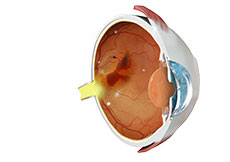 Diabetic Retinopathy