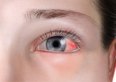 Eye Infection