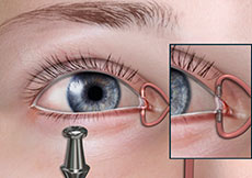 Eye Occlusion