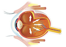 Glaucoma