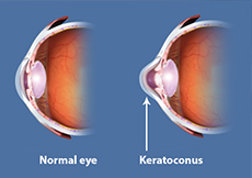 Keratoconus