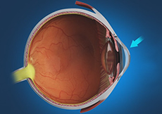 Keratoconus