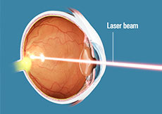 Laser Vision Correction
