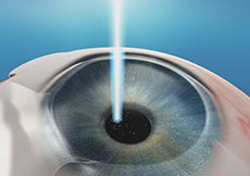 LASIK, PRK and ICL (Implantable contact lenses)Co-Management