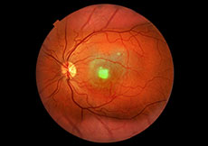 Macular Dystrophy