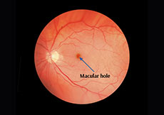 Macular Hole