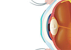 Orthokeratology (Ortho-K) & Myopia Control