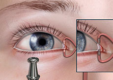Punctal Occlusion for Dry Eyes