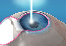 Refractive Surgery Co-Management