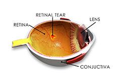 Retinal Tear, Retinal Hole and Retinal Detachment